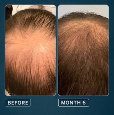 Patient hair growth before and after using Happy Head