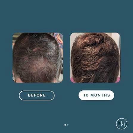 Female patient hair growth before and after using Happy Head