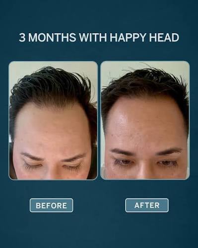 Male patient hair growth before and after using Happy Head